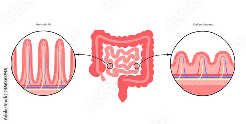 Celiac disease inflammation