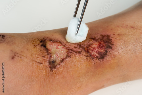 close up doctor cleaning wound on leg, Injuries from falling