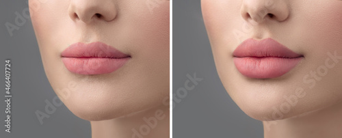 Fotografie, Obraz Before and after lip filler injections