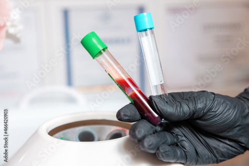 Plasmolifting. Preparation of blood for beauty injections. Cosmetologist holds two vials in hands - with blood and an empty one. Close up. The concept of medical test and biochemistry