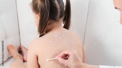 Female being treated with chickenpox rash on little girl's body with atiseptic cream at home. The causative agent of chickenpox is the varicella-zoster virus Varicella Zoster photo