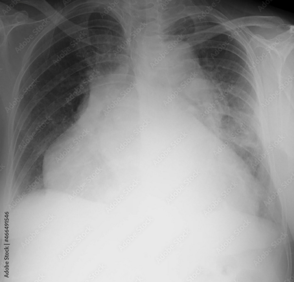 X ray image of cardiomegali radiology X ray image of cardiomegali radiology