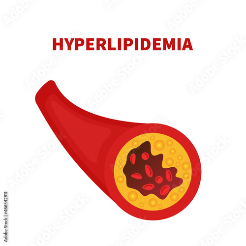 Hyperlipidemia disease. Narrowed blood artery vessel blocked with a clot. High cholesterol risk factor. Medical concept. Vector illustration. photo
