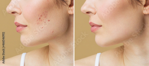 Young woman before and after acne treatment. Skin care concept.