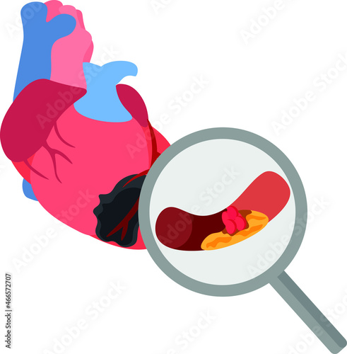 Illustration depicting myocardial infarction as a result of the formation of coronary artery thrombosis. Acute coronary syndrome. Heart disaster. Myocradial muscle necrosis. Emergency cardiology.