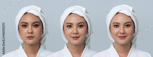 Comparison portrait of a beautiful Asian woman after treatment to new skin. Dark spots, Face scars, Dead skin cells on face. Effect from coronavirus protective gear N95 mask for healthcare worker photo