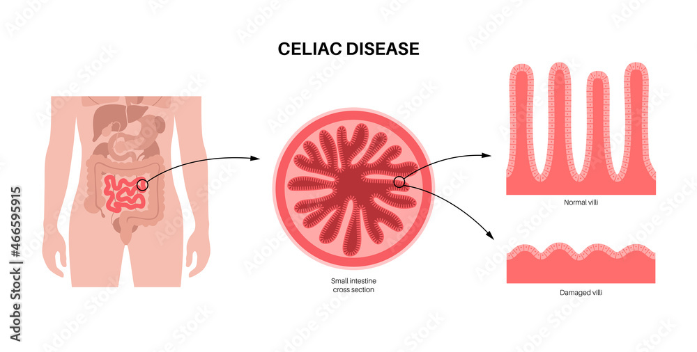 Foto Celiac disease inflammation