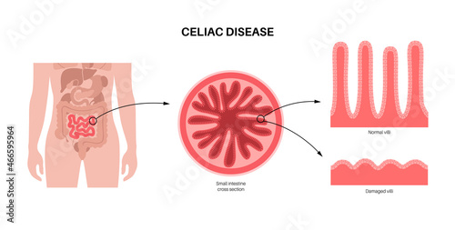 Celiac disease inflammation