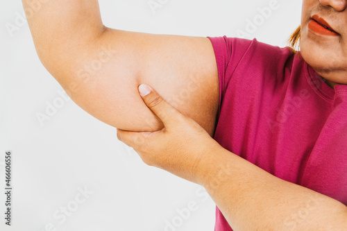 Fat Asian woman touches her right arm, pulling unwanted fat cellulite under her arm with anxiety and shedding her unattractive figure : Concept Health care of obese women