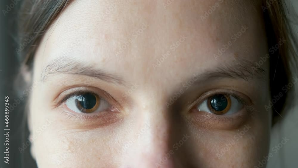 Closeup of a woman's brown eyes with dilated big pupils. Eye drops