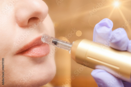 Lip augmentation treatment hyaluron pen device photo