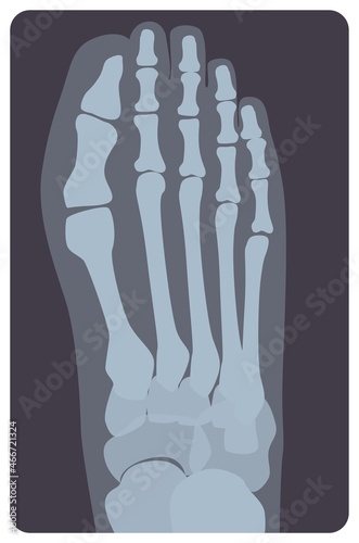 Superior radiograph of human right foot or limb. X-ray picture or radiographic monitor image of metatarsus bones and toes, top view. Medical radiology. Monochrome vector illustration in flat style