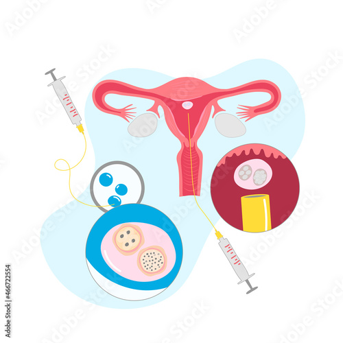 vector illustrations for gynecology. In vitro fertilization treatment of infertility, ovary cycle strokes, and font expended. 