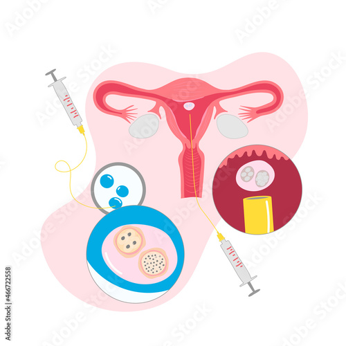 vector illustrations for gynecology. In vitro fertilization treatment of infertility, ovary cycle strokes, and font expended. 