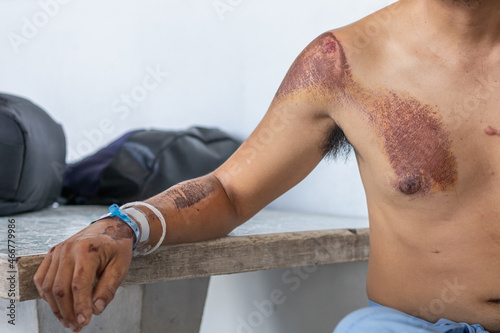 The young man's injuries to his arms and hands recovered after a motorcycle accident, causing injuries to his arms and hands before being hospitalized until his injuries and wounds improved. photo