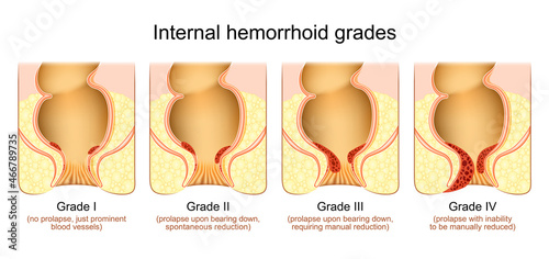hemorrhoid grades. Stage of Internal piles photo