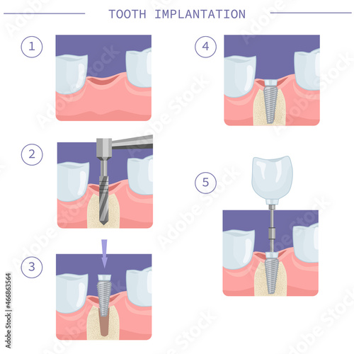 Immediate dental implantation. Modern dental implantation, step by step instructions. Vector illustration for dental textbooks