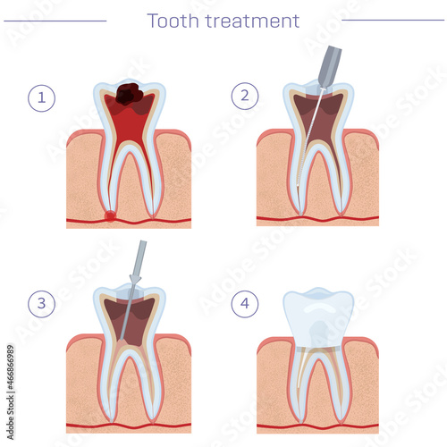 Tooth treatment, step by step instructions. Endodanic treatment, modern dentistry. Vector illustration for dental textbooks