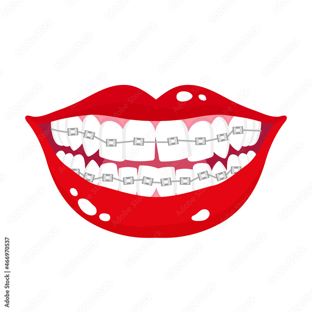 Obraz premium Vector cartoon smiling mouth with stages of crooked teeth alignment using orthodontic metal braces.