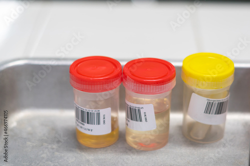urine samples in the laboratory in the hospital