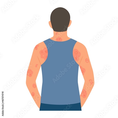 Dermatological skin disease, psoriasis.Allergic itching, skin inflammation, redness and irritation.Guttate psoriasis.Skin problems.isolated, vector.