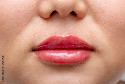 Lip augmentation. Beautician injects hyaluronic acid into the lips of a girl with a syringe. The cosmetologist doctor performs the procedure in the cosmetology office. Plastic surgery.