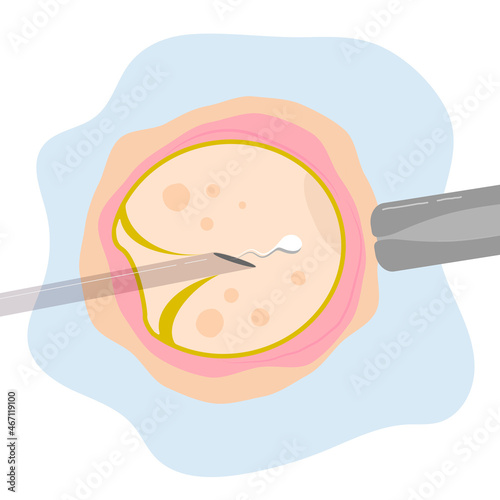 Vector colored  illustration intracytoplasmic sperm injection, ICSI, as part of IVF process