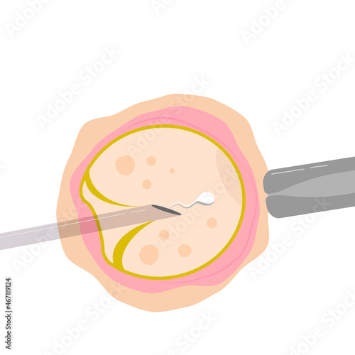 Vector colored  illustration intracytoplasmic sperm injection, ICSI, as part of IVF process