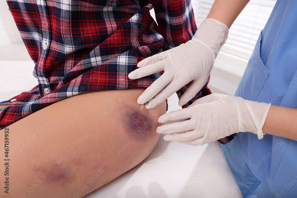 Doctor examining patient's bruised hip in hospital, closeup