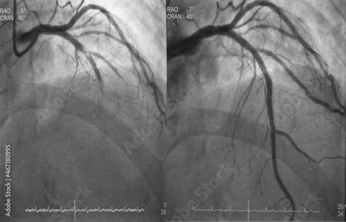 Comparison of pre-post percutaneous coronary intervention (PCI) at proximal to mid left anterior descending artery (LAD) with drug eluting stent (DES). photo
