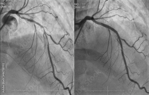 Comparison of pre-post percutaneous coronary intervention (PCI) at proximal to mid left anterior descending artery (LAD) with drug eluting stent (DES) Fototapet