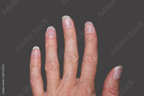Foto Close- up of bitten and brittle nails without manicure