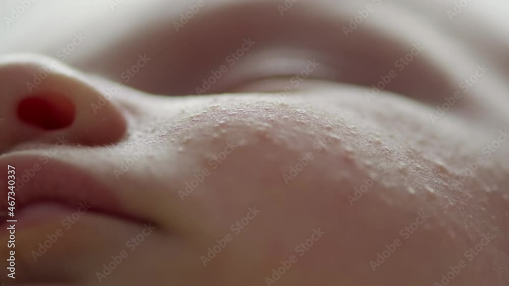 Macro shot of a sleeping childs face affected by diathesis. Troubled face skin of a small caucasian baby. childs face with skin defect. Closeup footage of babies cheecks. Macro shot of a sleeping childs face affected by diathesis. Troubled face skin of a small caucasian baby. childs face with skin defect. Closeup footage of babies cheecks.