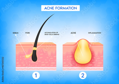Formation of skin acne or pimple. Accumulation of dead cells and inflammation associated with pimples. The sebum in the clogged pore promotes the growth of a certain bacteria. 3D vector illustration.