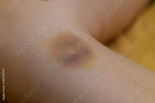closeup bruise on woman's leg. wounded skip, violence concept