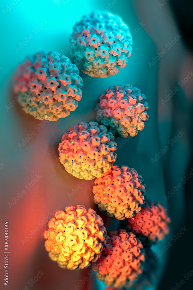 Human papillomavirus infection. Virus. HPV is the most common sexually