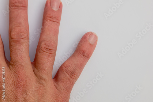 Adult male hand showing distortion and deformity of little finger due to malunion of bone fracture