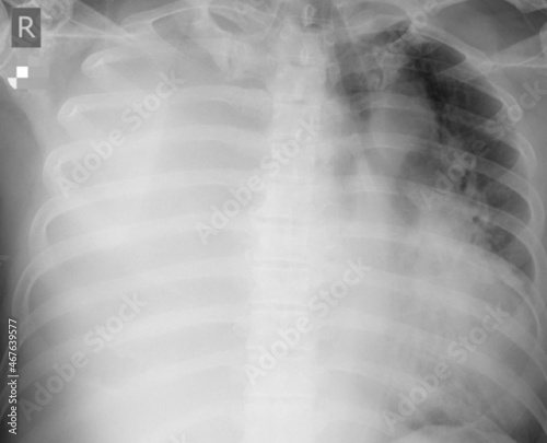 Chest x ray image of masive pleura effusion  photo