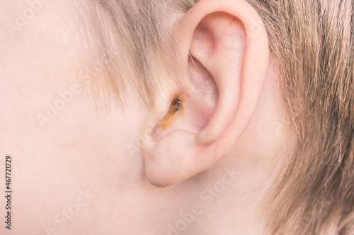 earwax in a dirty ear of child close up. ear hygiene photo