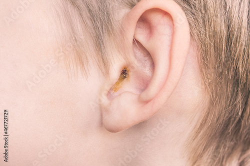 earwax in a dirty ear of child close up. ear hygiene