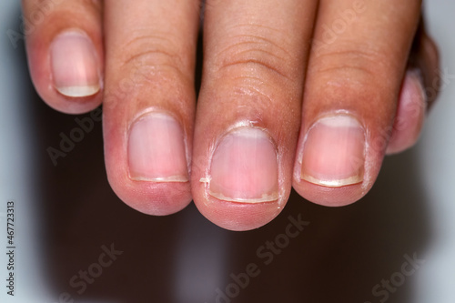 Closeup hangnail in fingers. Nail problem in hand. photo