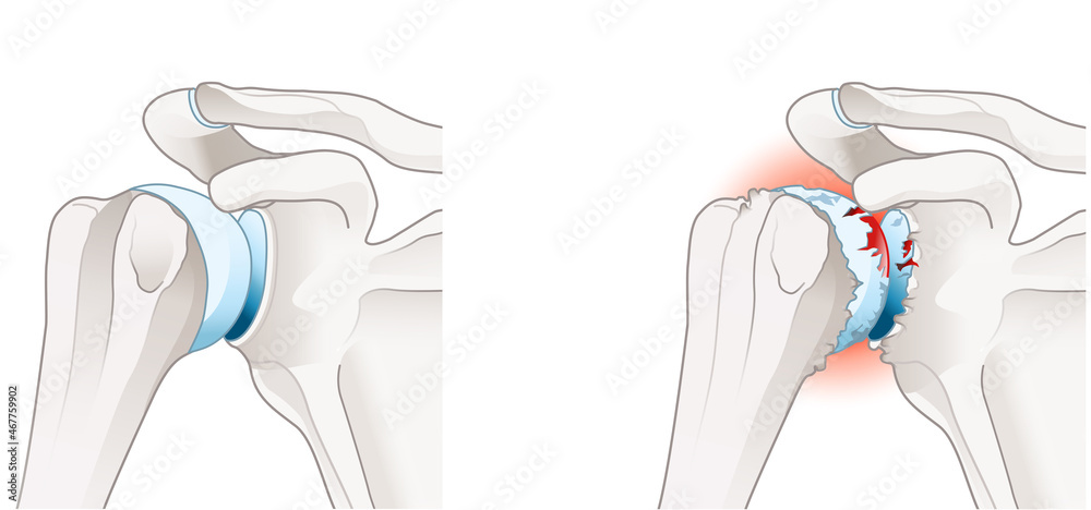 Osteoarthritis of the shoulder joint - obrazy, fototapety, plakaty 