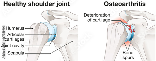 Photos Osteoarthritis of the shoulder joint