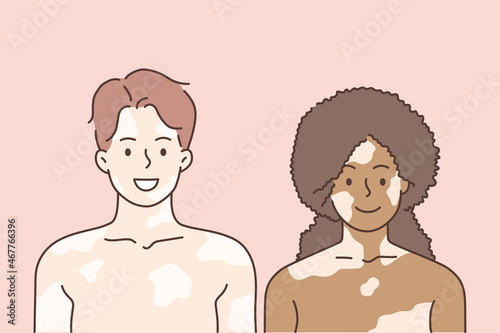 Vitiligo and mixed race love concept. Young smiling woman and man couple standing together having vitiligo on faces and bodies feeling love vector illustration 