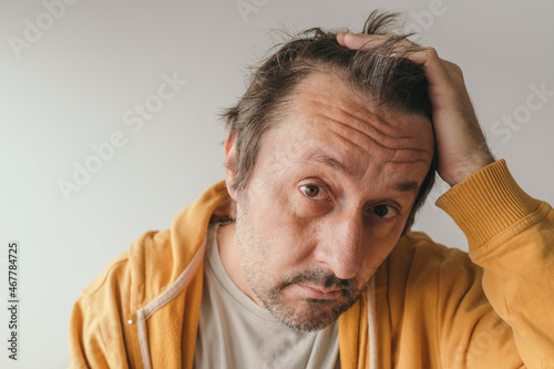 Canvas Print Hair loss, man looking at the mirror concerned about losing his hair at forehead