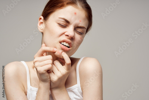 pretty woman in a white t-shirt pimples on the face close-up