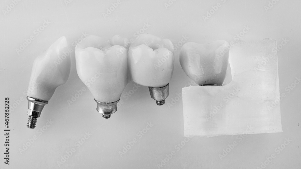 Temporary dental crowns of chewing teeth, top view in black and white