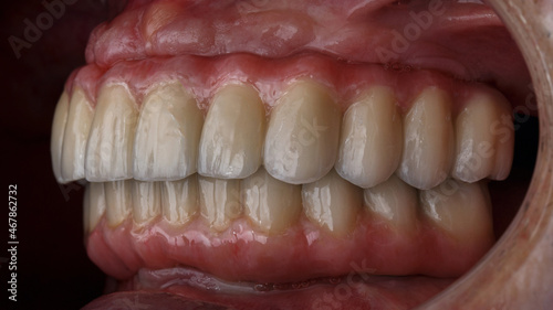 Ceramic Dental Prostheses of the upper and lower jaw in the bite in the oral cavity, view from