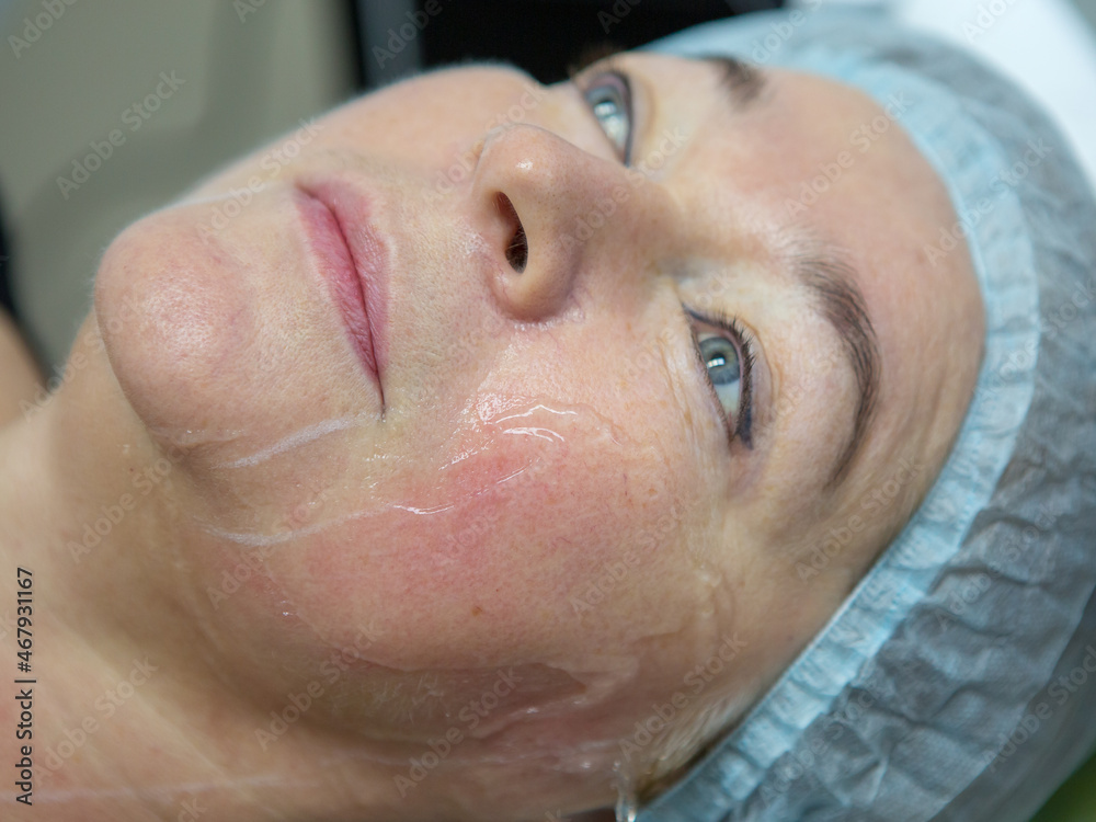 Non-surgical face lifting. SMAS lifting ultrasonic. The process of rejuvenation. Hardware cosmetology. contour face plastic. Dermatologist doctor make a Caucasian woman an ultrasound facelift Non-surgical face lifting. SMAS lifting ultrasonic. The process of rejuvenation. Hardware cosmetology. contour face plastic. Dermatologist doctor make a Caucasian woman an ultrasound facelift