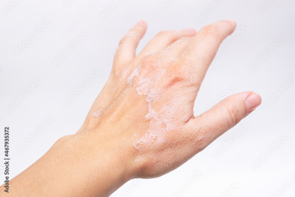Close-up of a female hand with peeling skin on the back of the hand isolated on a white background. Allergies, eczema, psoriasis, lack of vitamins, erythema Close-up of a female hand with peeling skin on the back of the hand isolated on a white background. Allergies, eczema, psoriasis, lack of vitamins, erythema